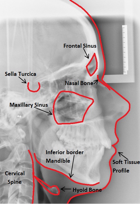 Cephalometrics1